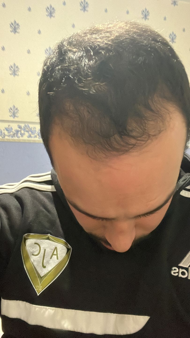Customer photo review of Good Hair Men Anti-chute homme - 1 mois