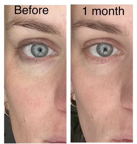 Customer photo review of EvenSkyn® Lumo: Premium Anti-Aging & Skin Tightening Handset