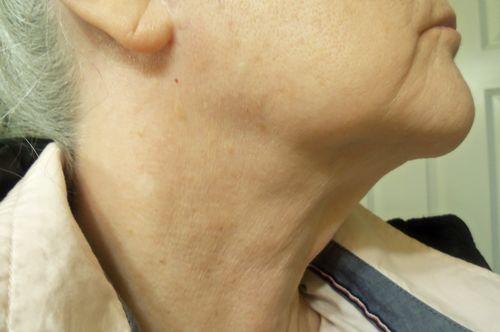 Customer photo review of EvenSkyn® Lumo: Premium Anti-Aging & Skin Tightening Handset