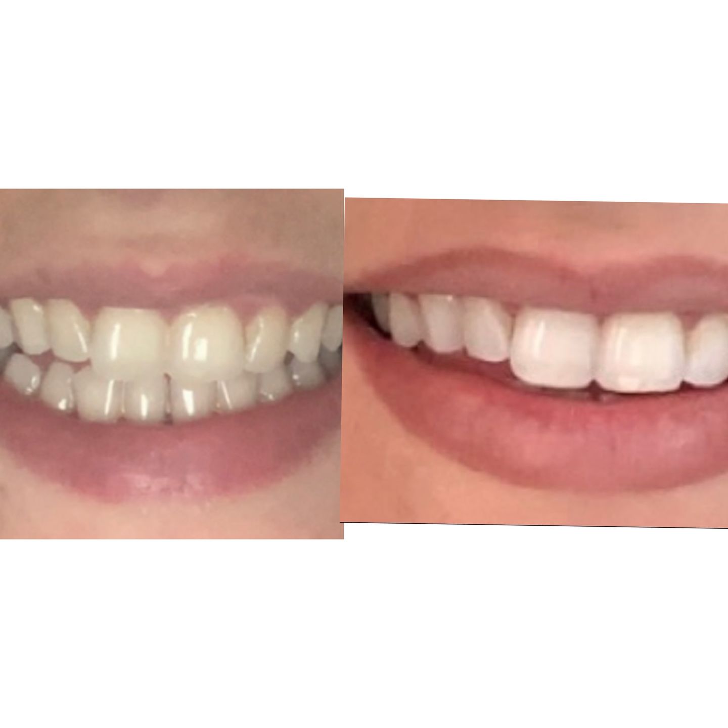 Customer photo review of Teeth Whitening Strips