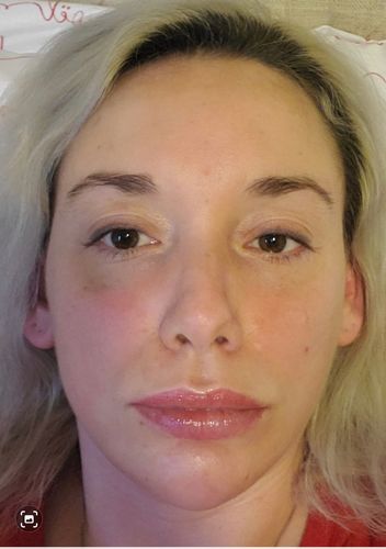 Customer photo review of EvenSkyn® Lumo: Premium Anti-Aging & Skin Tightening Handset