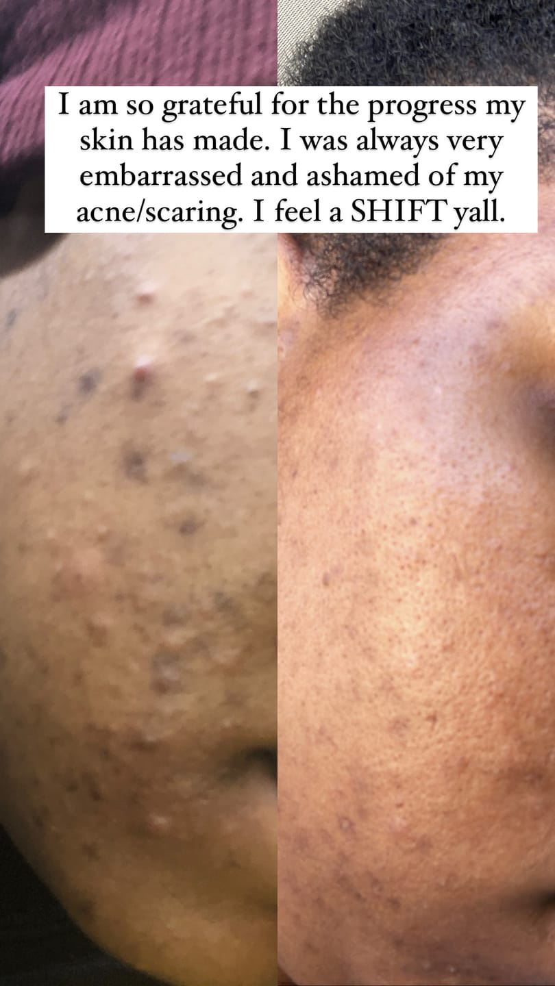 Customer photo review of 24k Golden Glow Essential Acne Kit