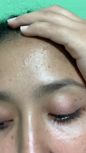 Customer photo review of Salicylic Acid 2% Exfoliating Blemish Solution 30ml