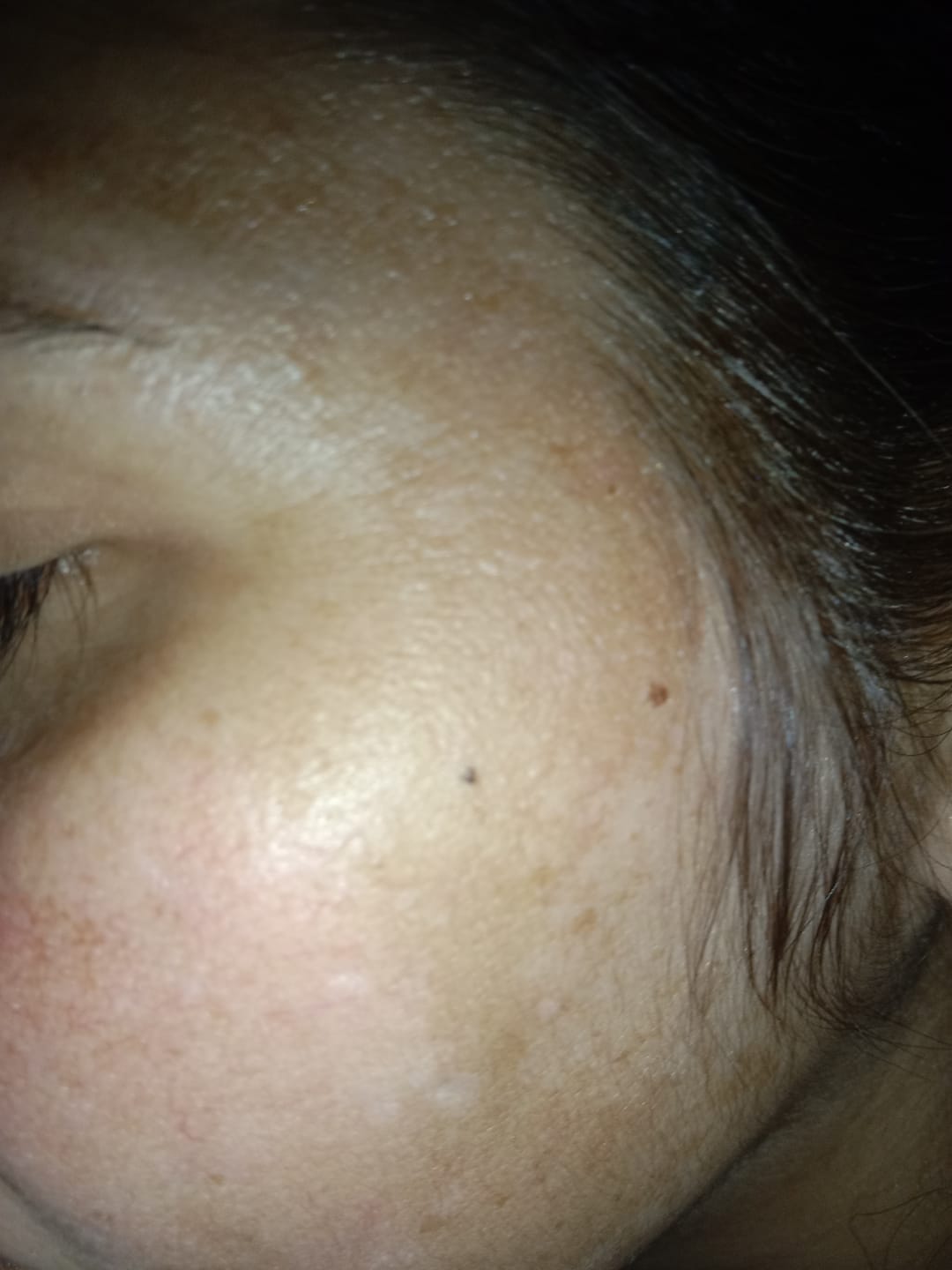 Customer photo review of SPECIAL PIGMENTATION BUNDLE (MELASMA, FRECKLES & DARK SPOTS)
