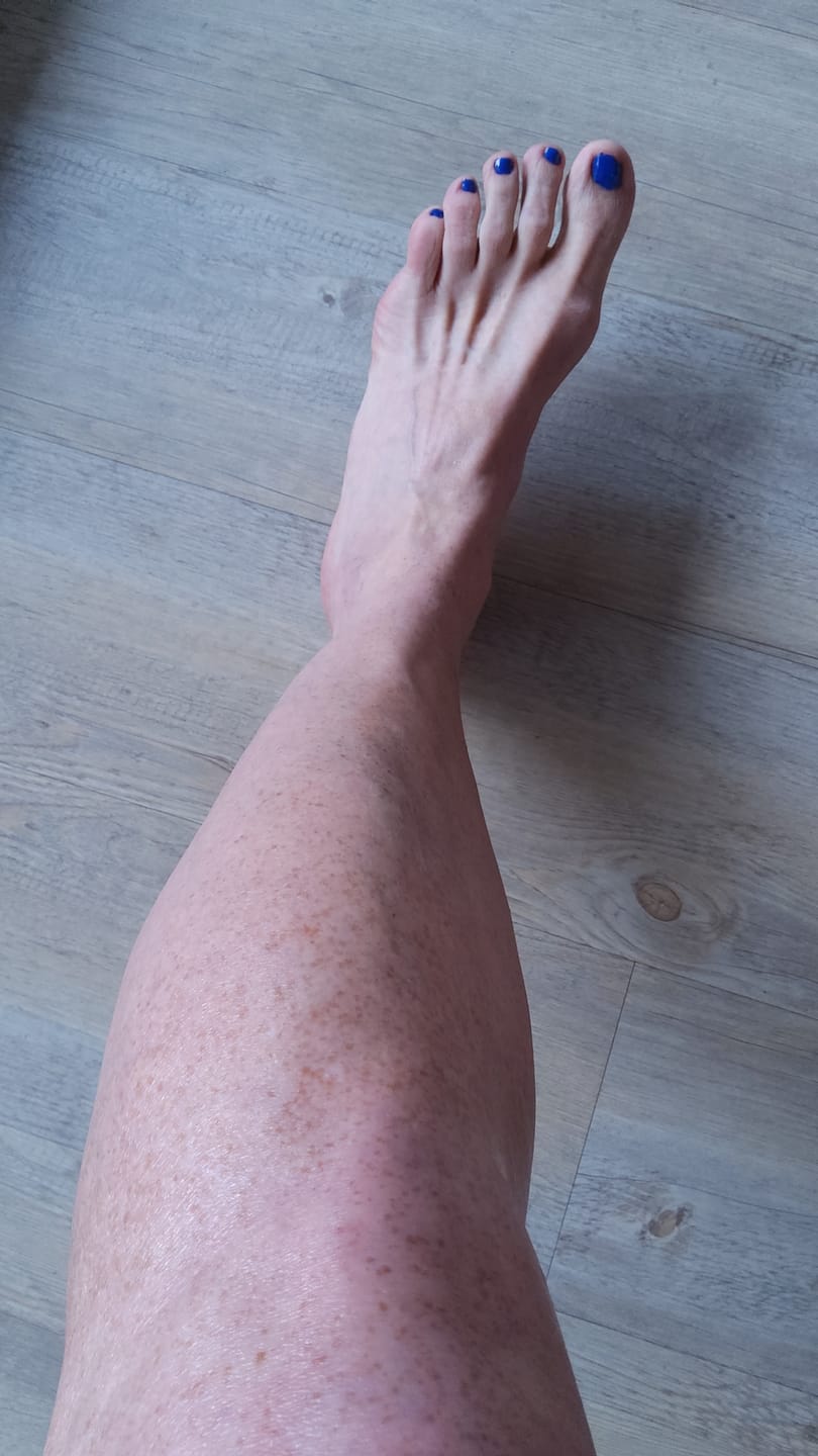Customer photo review of [VIP only] Belle Body IPL ULTRA+