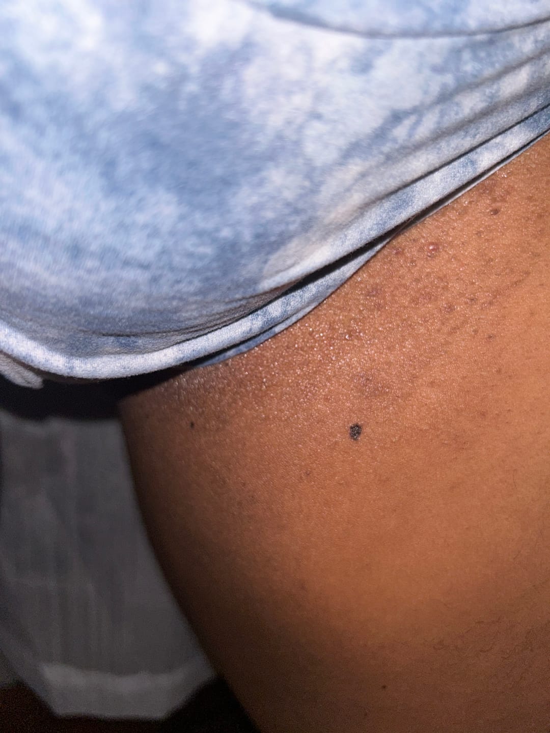 Customer photo review of Magic Eraser Dark Spot Cream