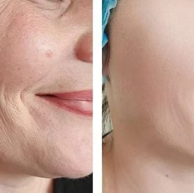 Customer photo review of DermaLux™ Korean Dermalayr Technology Soluble Collagen Film