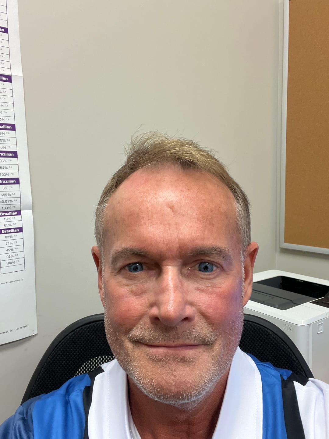 Customer photo review of New York Blue Prescription Coloured Contact Lenses