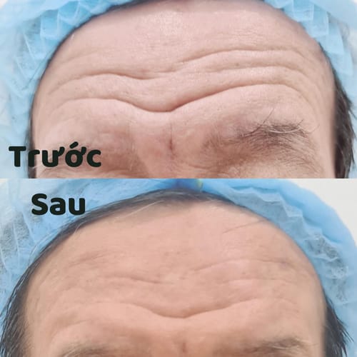 Customer photo review of Femvy Blackhead Remover 2.0
