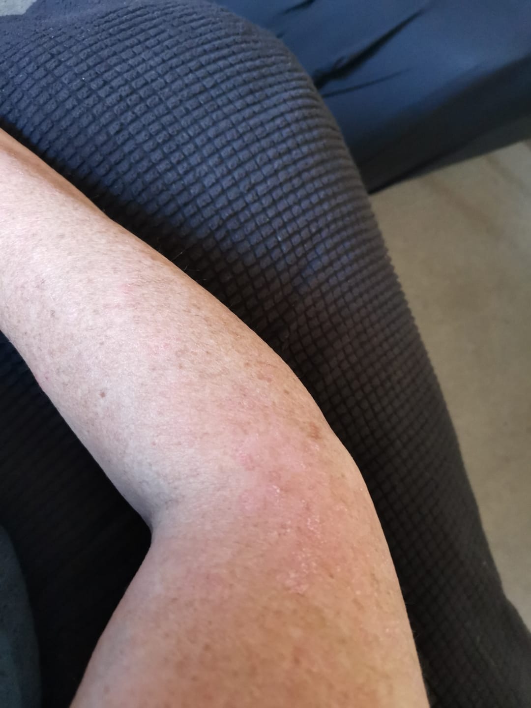 Customer photo review of Skin Hydration Duo - Kawakawa Balm + Kawakawa Oil