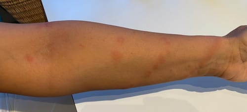 Customer photo review of קרם גוף טיפולי לעור אדמומי, מגורה ומתקלף | PSO SKIN BODY CREAM