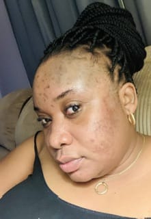 Customer photo review of Anti-Acne Beauty Bar for Oily Skin