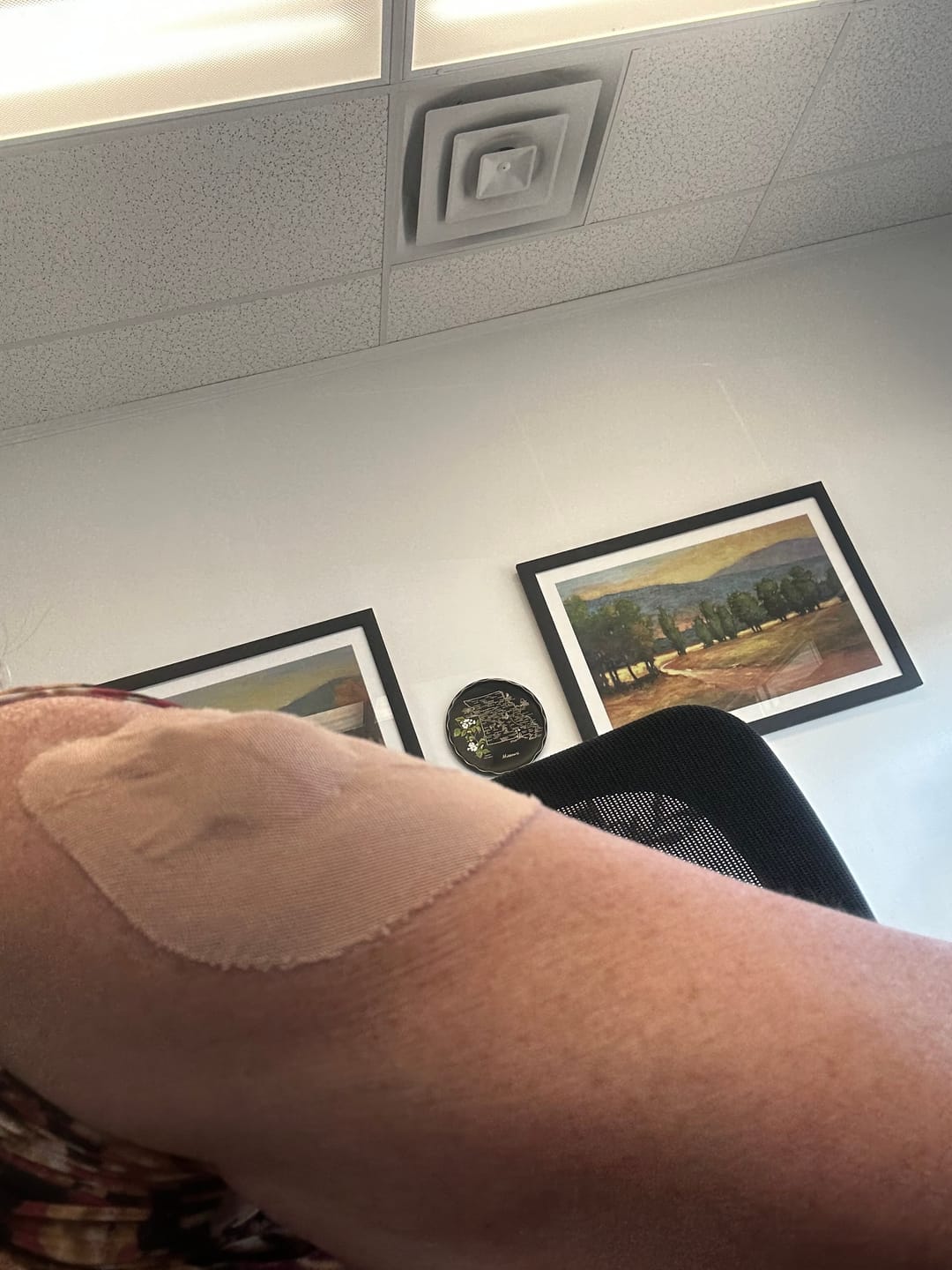 Customer photo review of Skin Grip Original - Medtronic Guardian/Enlite Adhesive Patches