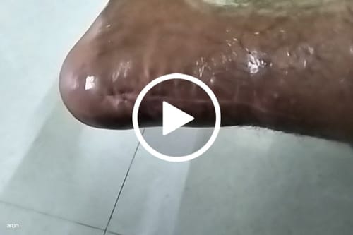 Customer video review of Pneumatic Walker Boot (Single Push Button - Long Type with 17" Height)