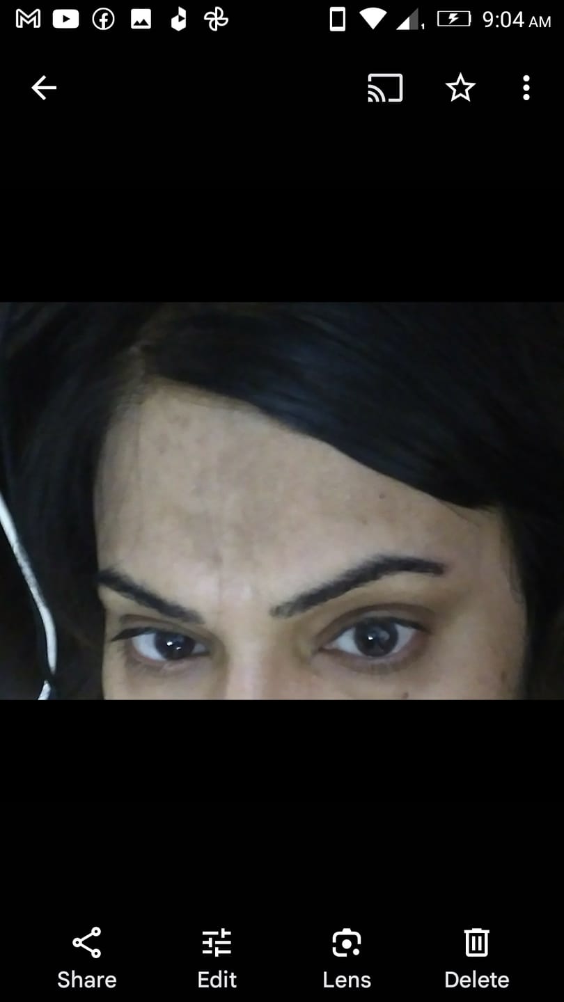 Customer photo review of SPECIAL PIGMENTATION BUNDLE (MELASMA, FRECKLES & DARK SPOTS)