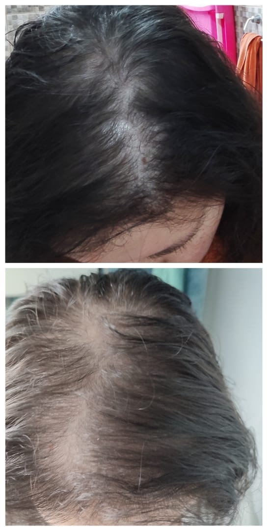 Customer photo review of Tratamiento anticaída 1 mes + Biotina