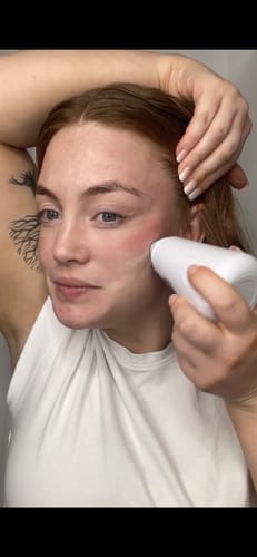 Customer photo review of Microdermabrasion Kit
