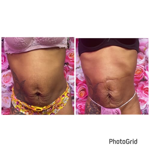 Customer photo review of MesoFirm Serum