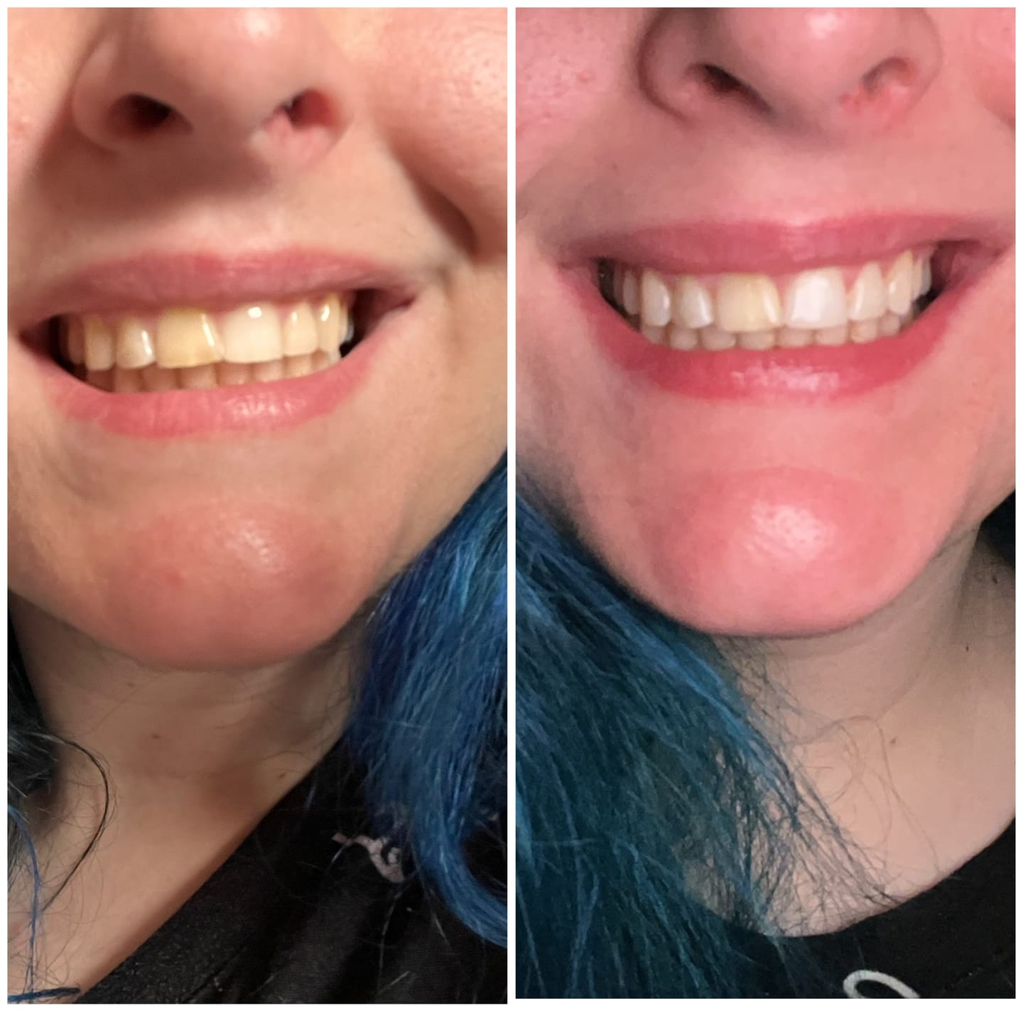 Customer photo review of Teeth Whitening Strips