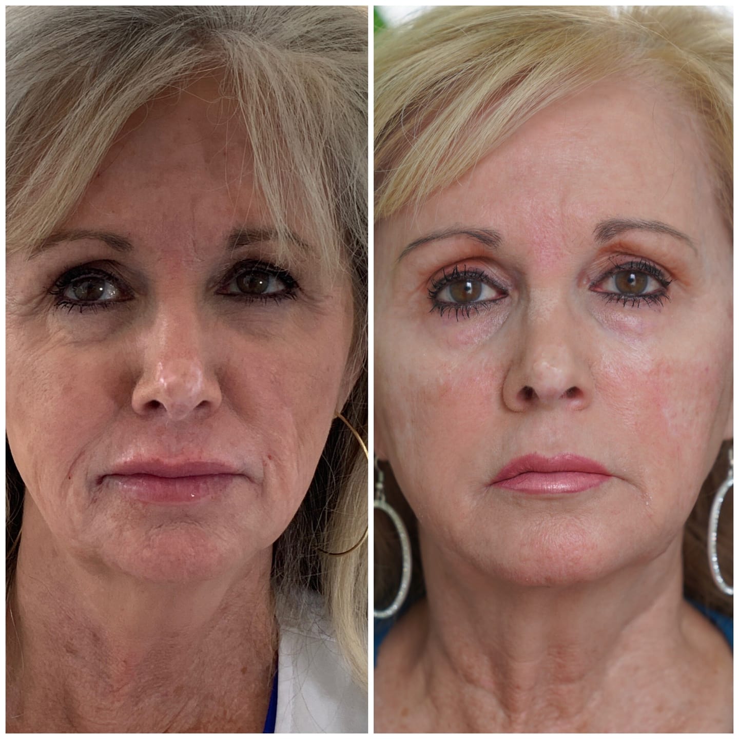 Customer photo review of Bliss™ Collageen Proteine