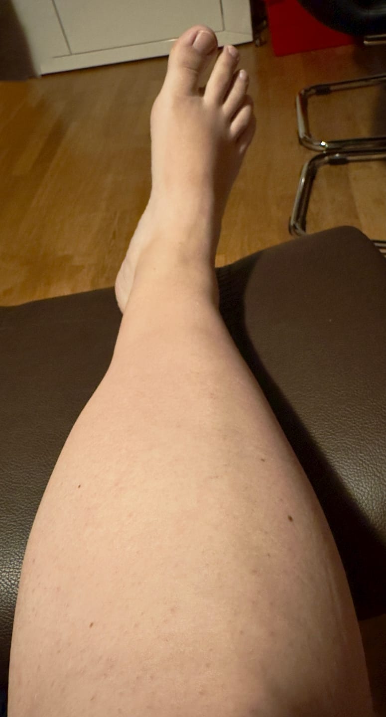 Customer photo review of [VIP only] Belle Body IPL ULTRA+