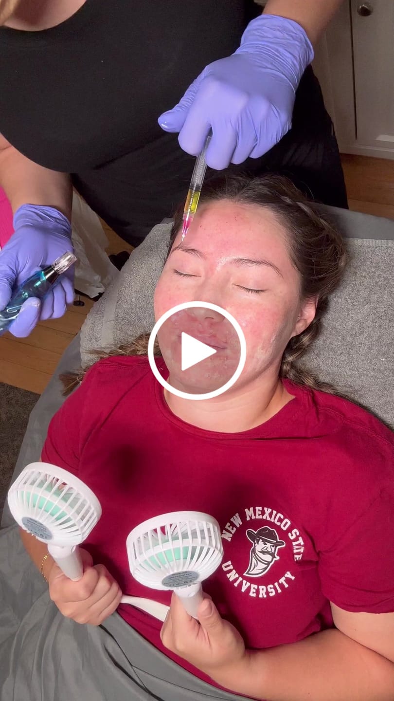 Customer video review of Reset Skin System Dermal Needling Device