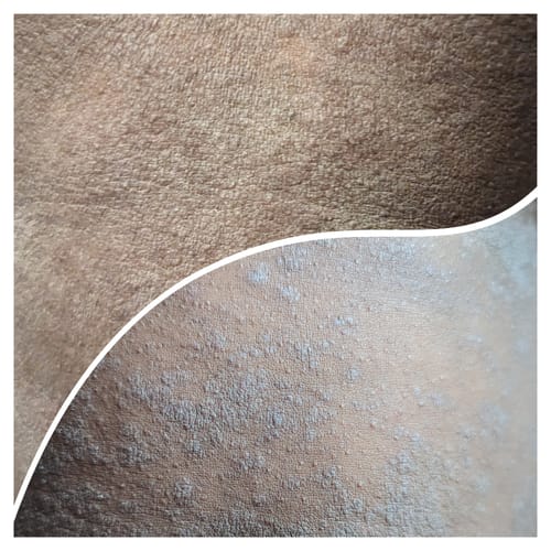 Customer photo review of Eczema Recommendations