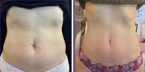 Customer photo review of Adonis 9 in 1 Cavitation Machine for Toning & Slimming
