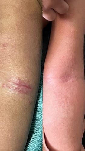 Customer photo review of Eczema Scratch Mitten