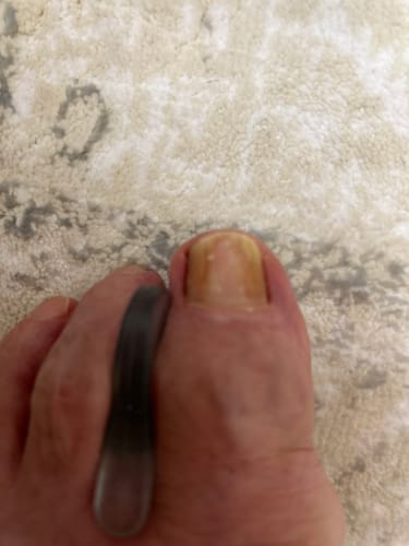 Customer photo review of Antifungal Laser Enhancer