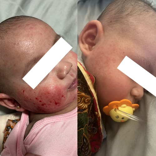 Customer photo review of Eczema Scratch Mitten