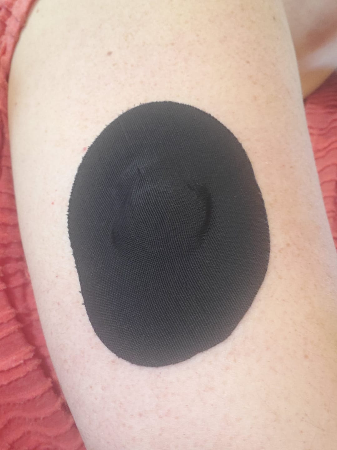 Customer photo review of Skin Grip Original - Medtronic Guardian/Enlite Adhesive Patches