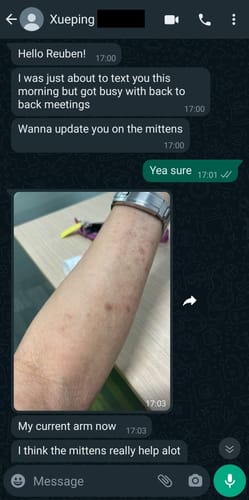 Customer photo review of Eczema Scratch Mitten