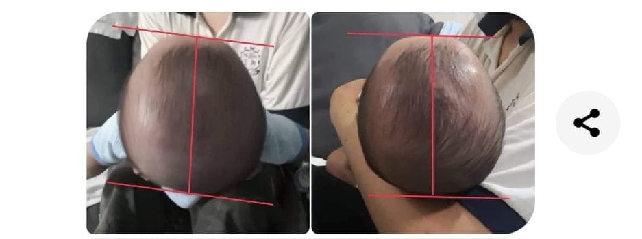 Customer photo review of BSB Head Shaping Pillow ( Upgrade.Ver )