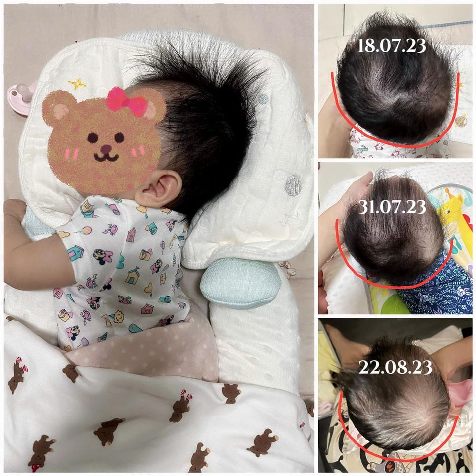 Customer photo review of BSB Head Shaping Pillow ( Upgrade.Ver )