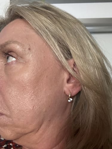Customer photo review of （🔥LAST DAY SALE-80% OFF) Lovefinity™ Lymphvity MagneTherapy Germanium Earrings