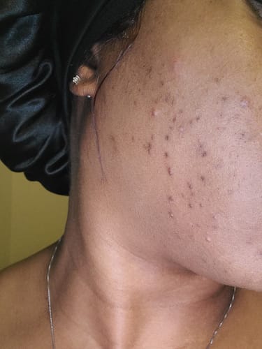 Customer photo review of BERRI-CLEAR+ 5 BERRY SUPERFRUIT SERUM