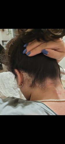 Customer photo review of ערכה טיפולית ליובש וקילופים בעור | PSO BODY & SCALP KIT