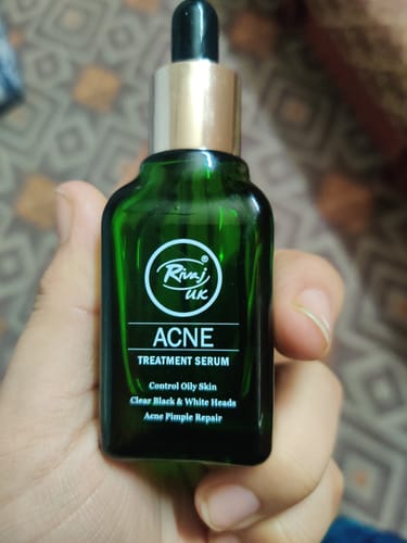 Customer photo review of Face Serum - Acne Treatment (30ml)