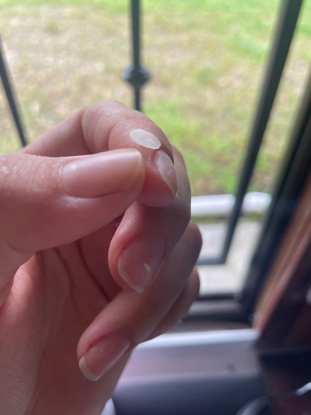 Customer photo review of Acne Pimple Master Patch (24 patches)