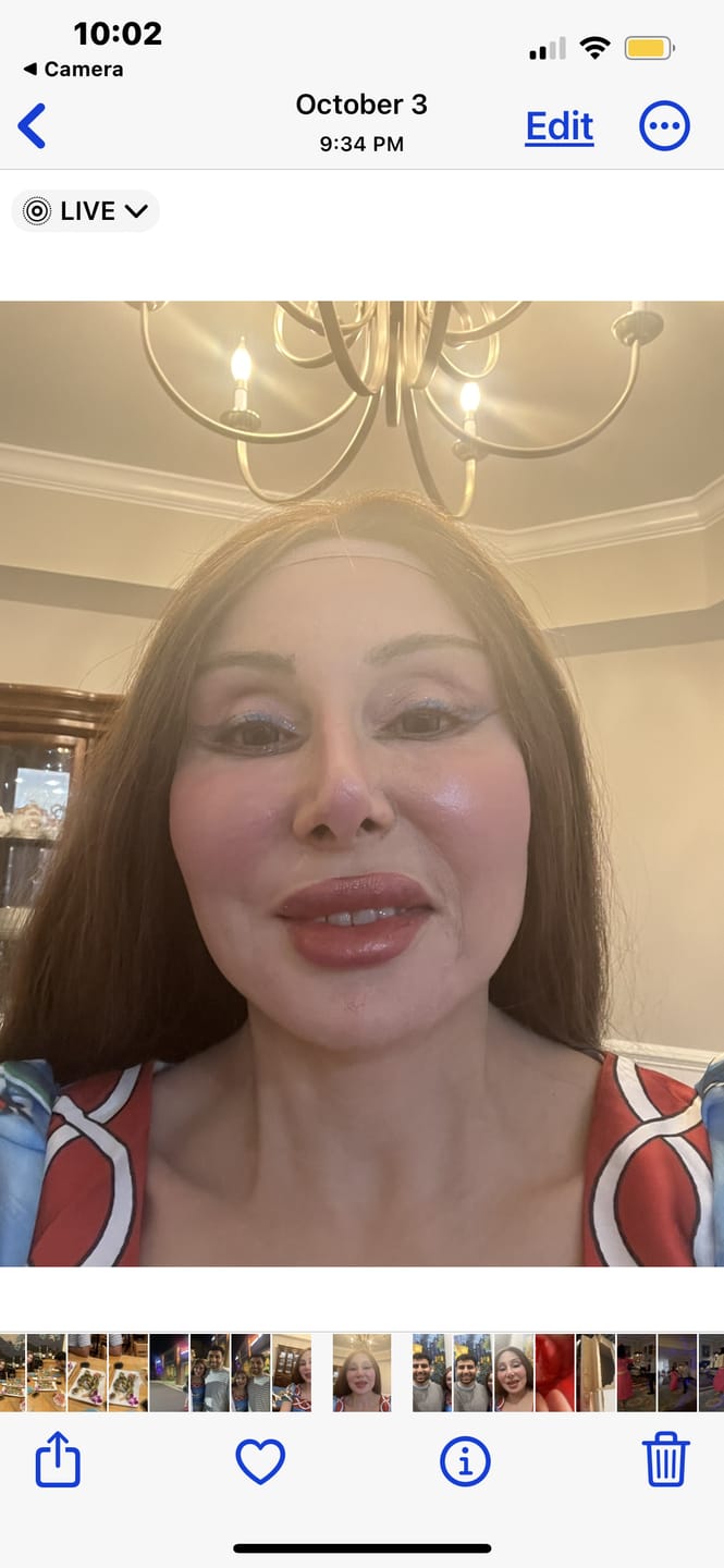 Customer photo review of Norko Blue Prescription Colored Contact Lenses