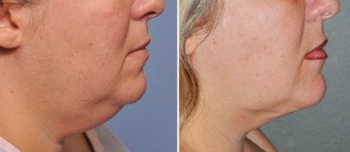 Customer photo review of 🔥Lymphdrainage-Schlankheitsohrringe (zeitlich begrenzter Rabatt 🔥 Letzter Tag)