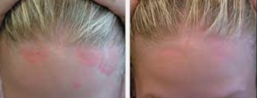 Customer photo review of 10-Day Heal Your Psoriasis Sample Kit