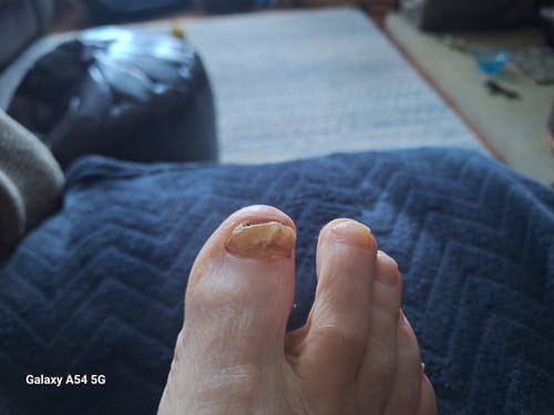 Customer photo review of Antifungal Laser Enhancer