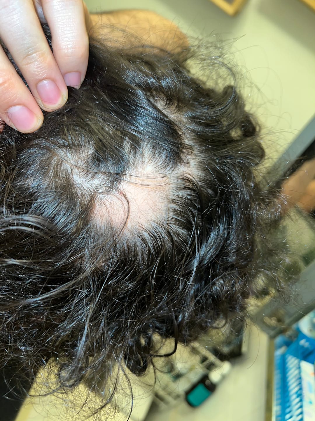 Customer photo review of Hair Growth Follicle Stimulator Spray by Advanced Trichology®