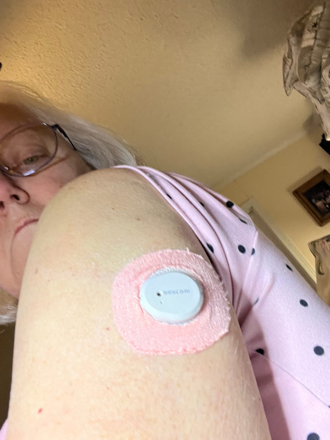 Customer photo review of Skin Grip Original - Dexcom G7 Adhesive Patches (With Cutout)