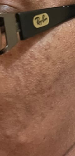 Customer photo review of Acne Pack