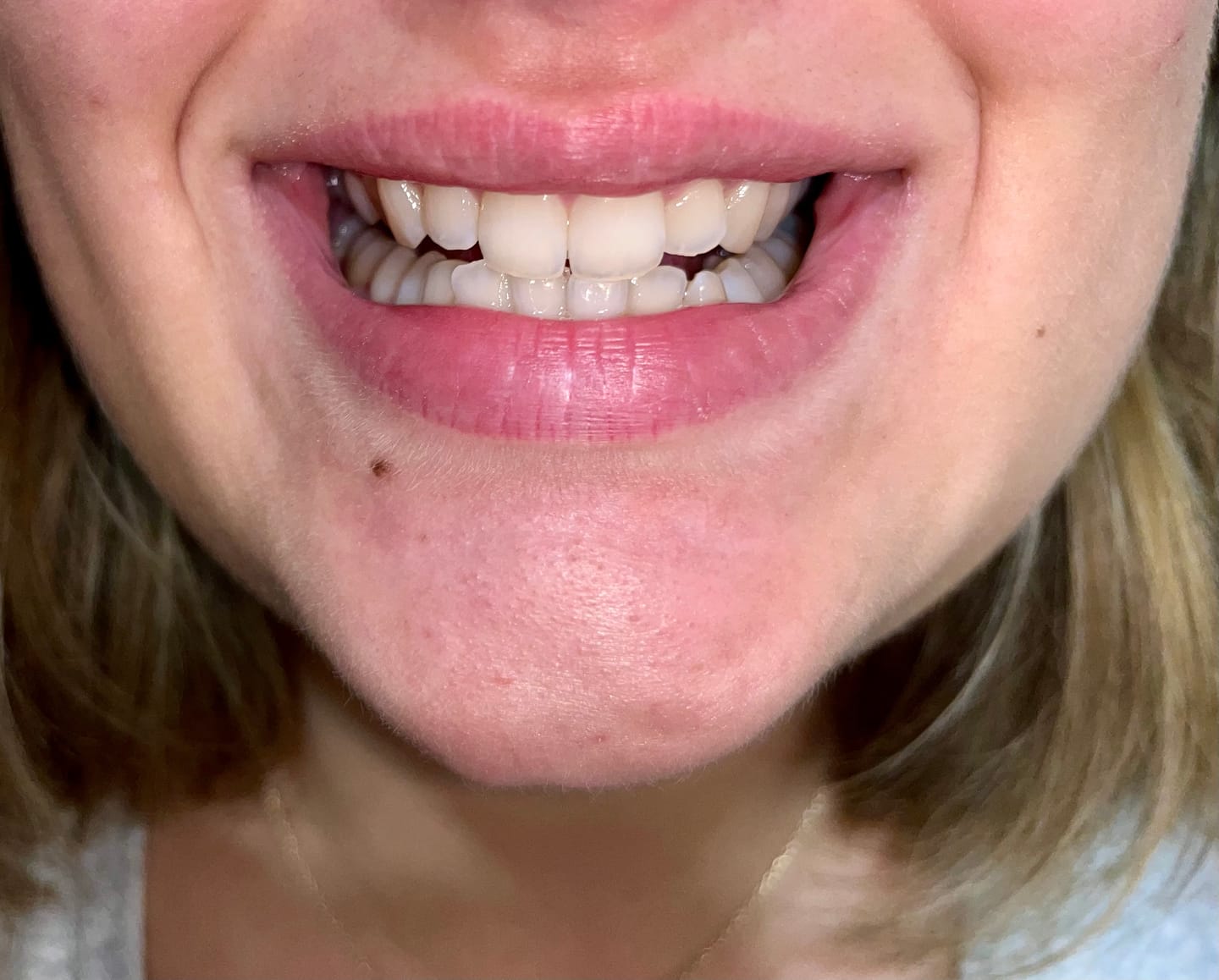 Customer photo review of ETERNAL TEETH WHITENING KIT