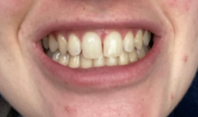 Customer photo review of Teeth Whitening Strips