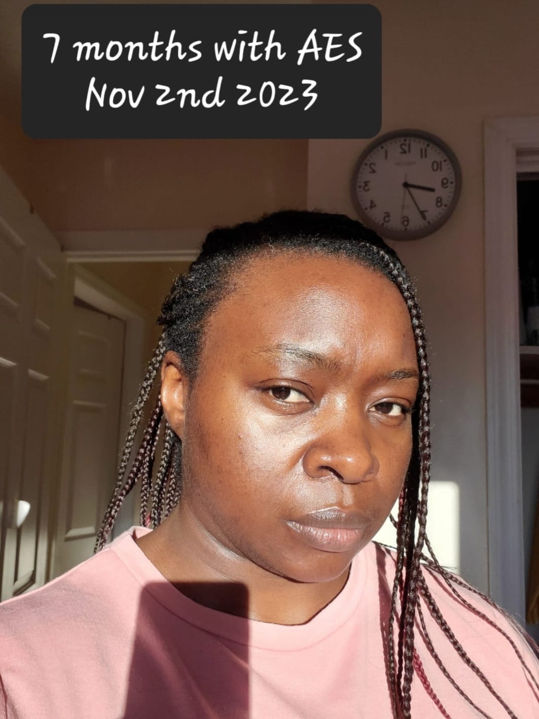 Customer photo review of CLEAR GLOW 30- ACNE SAFE SHEER SUNSCREEN